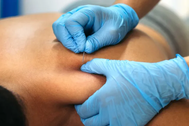 Service F: 30-minute Dry Needling Standard Consultation